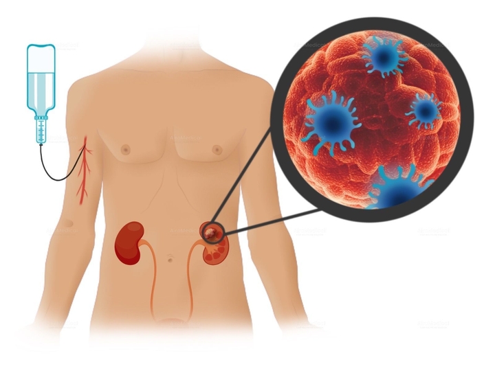 Brachytherapy for Prostate Cancer | iBrachy Center, Vivantes Clinic Am Urban