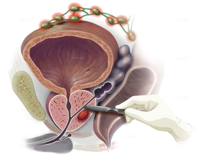 PSMA-Radioguided Surgery (PSMA-RGS) for Metastatic Lymph Nodes in Prostate Cancer at Urological Clinic of TUM Hospital Rechts der Isar