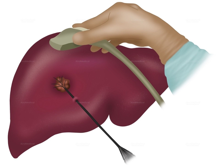 Microwave Ablation (MWA) | Uniclinic Frankfurt, Germany