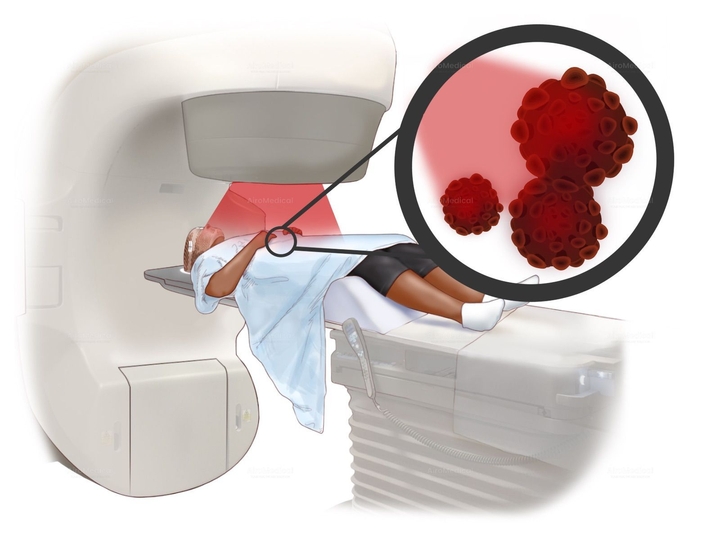 Gamma Knife Icon Stereotactic Radiotherapy at Gamma Knife Centre Krefeld
