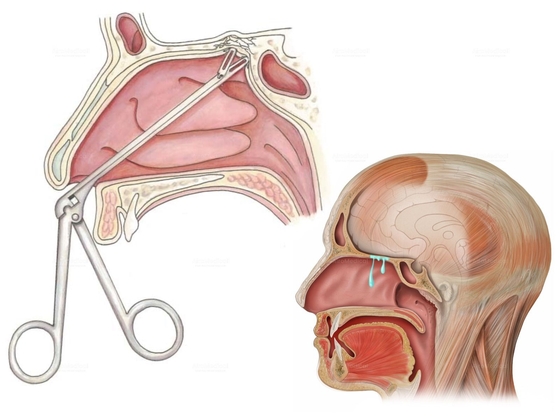 Cerebrospinal fluid leak treatment with surgical leak repair