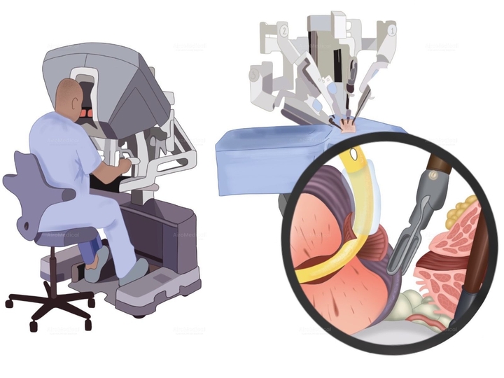 Robotic-Assisted Da Vinci Prostatectomy Surgery at Urological Clinic of TUM University Hospital Rechts der Isar
