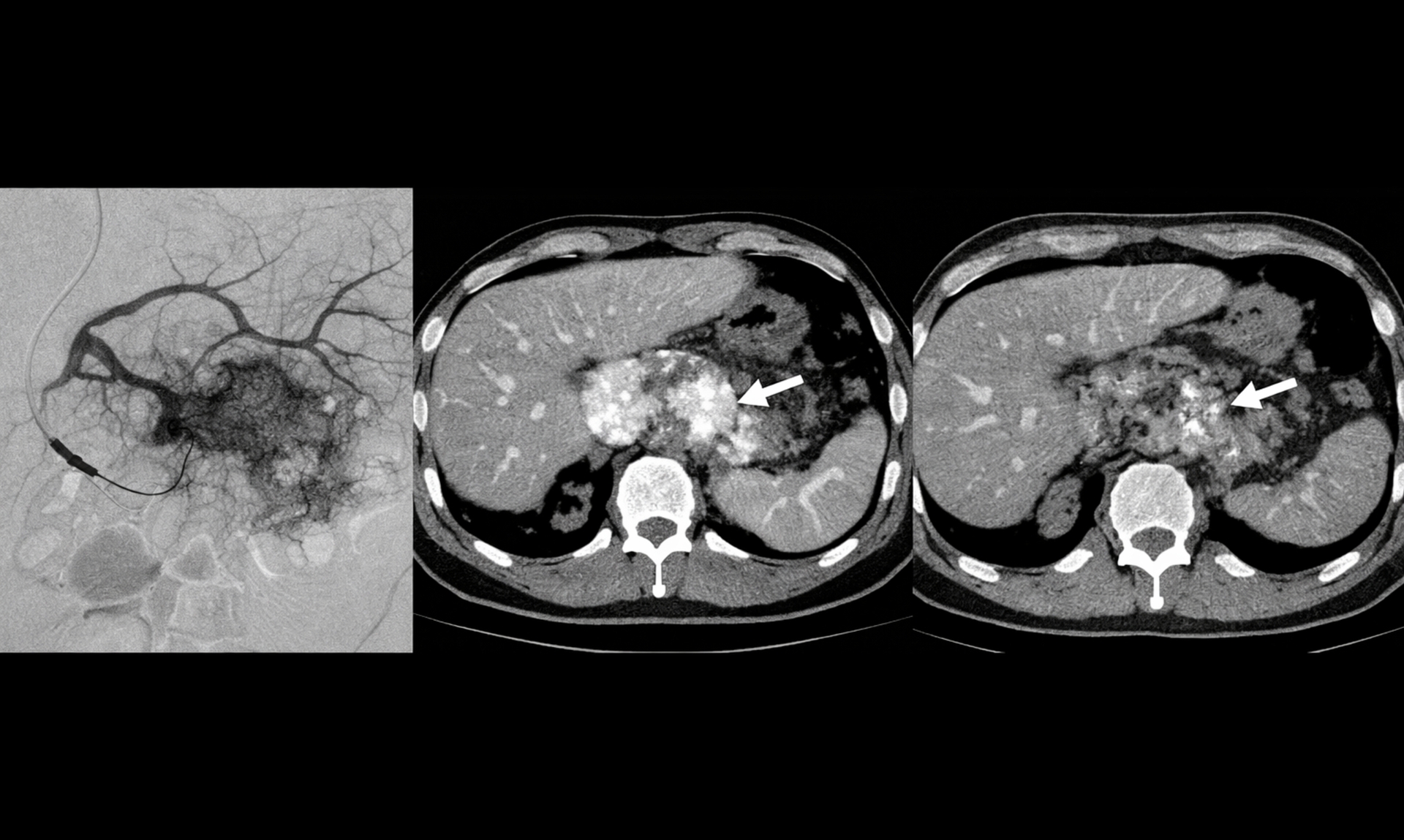 Interventional Oncology Case: TACE for Primary Pancreatic Tumor in Germany image