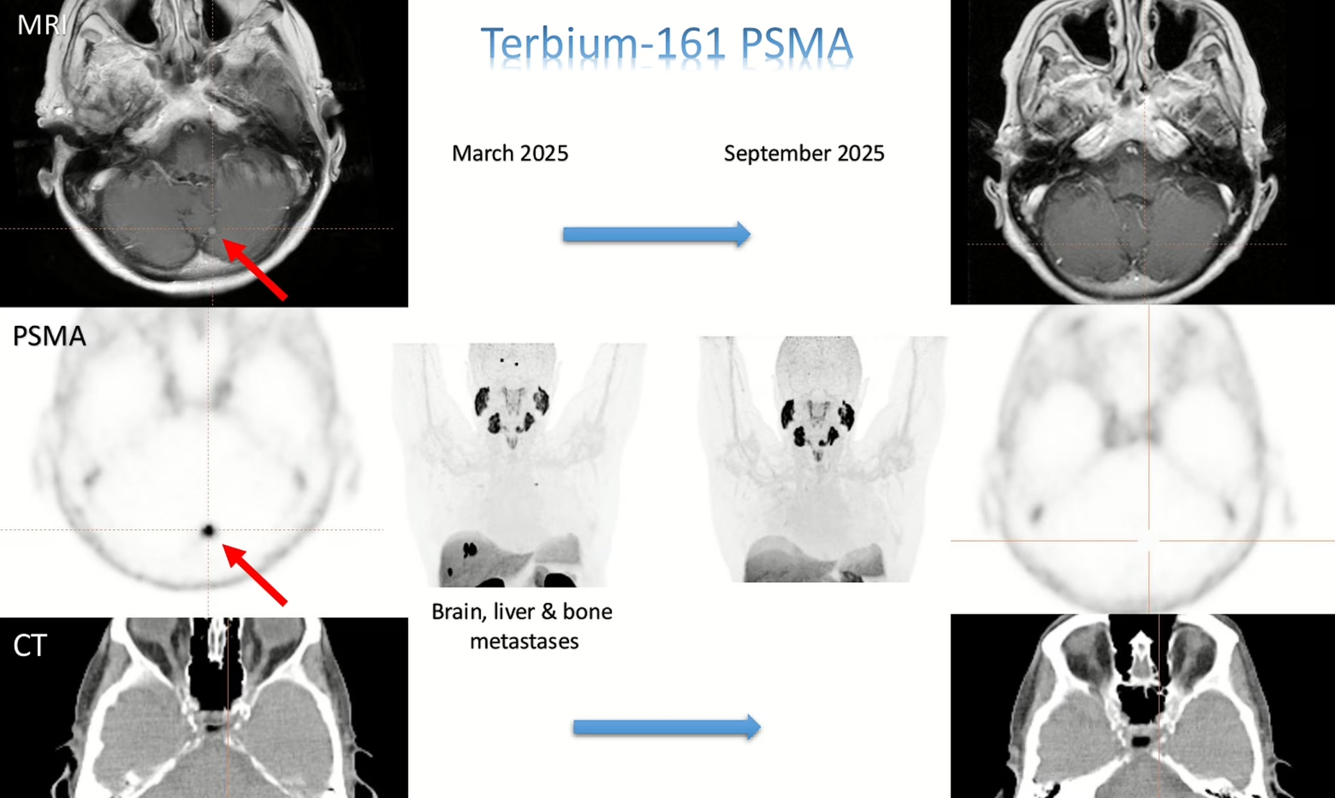 161 Terbium-PSMA Radioligand Therapy in Prostate Cancer Brain Metastases image