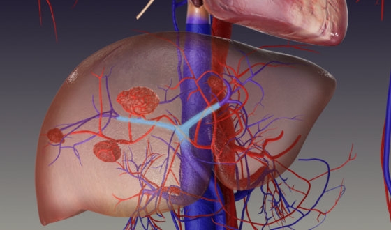 Radioembolization for Liver Cancer Treatment