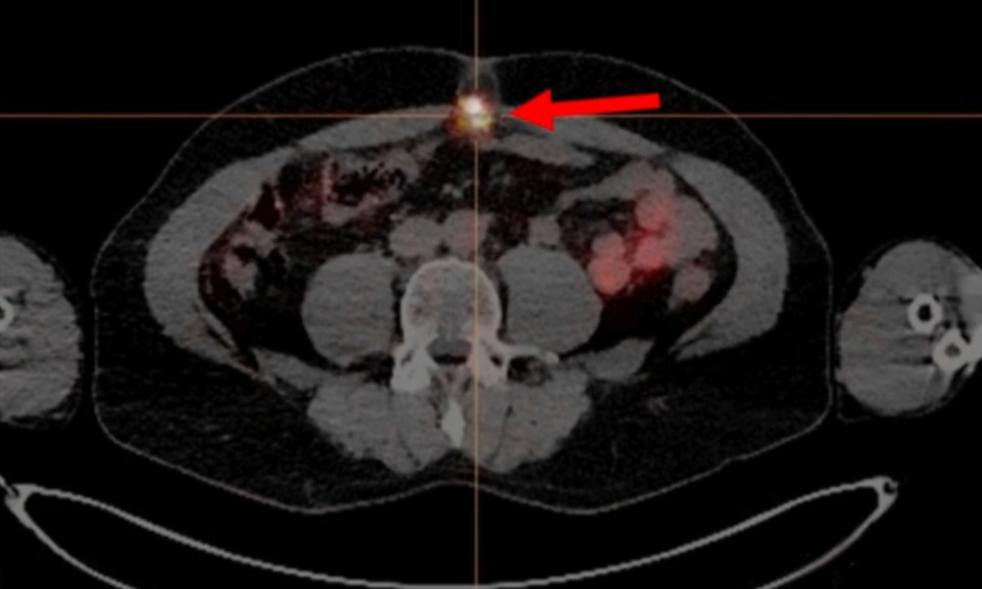 Personalized Theranostics in Occult Peritoneal Carcinomatosis from MINUTE Medical - Case Report image