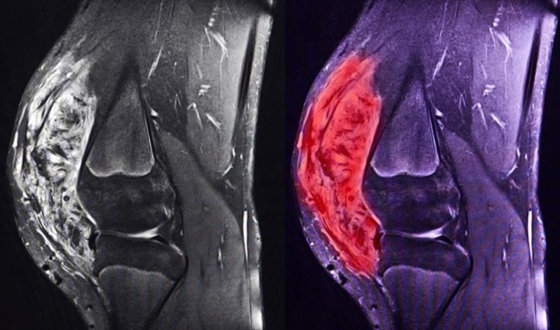 Sarcoma Guide image