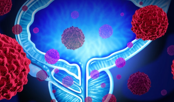 Prostate Cancer Treatment with Lutetium-177 image