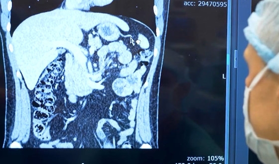 Liver Metastases Treatment Abroad