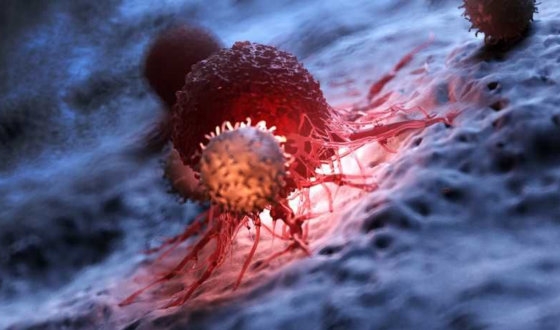 Metastatic Cancer Treatment in Germany image