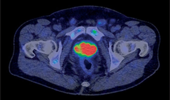 Lutetium-177 PSMA Therapy: Everything You Need to Know image