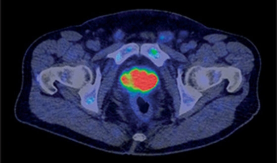 Lutetium-177 PSMA Therapy: Everything You Need to Know