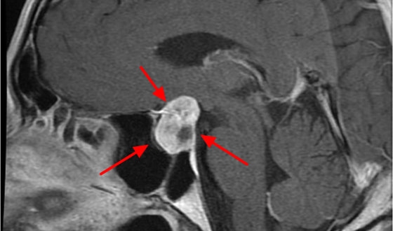 Pituitary Gland Tumor Guide