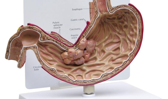 Stomach Cancer: About the Disease, Clinics and Alternative Treatments image