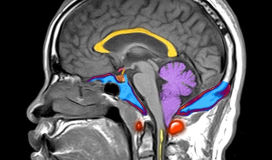 Chiari Malformation Guide image