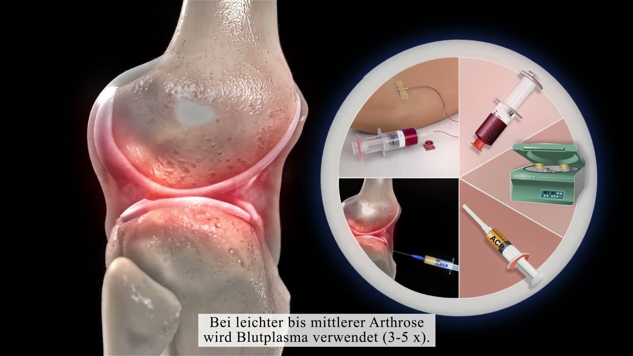 How does stem cell therapy with fat cells work for osteoarthritis?
