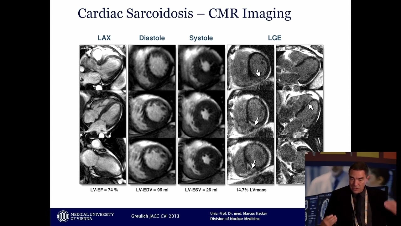 Advanced imaging of cardiac sarcoidosis – Prof. Marcus Hacker