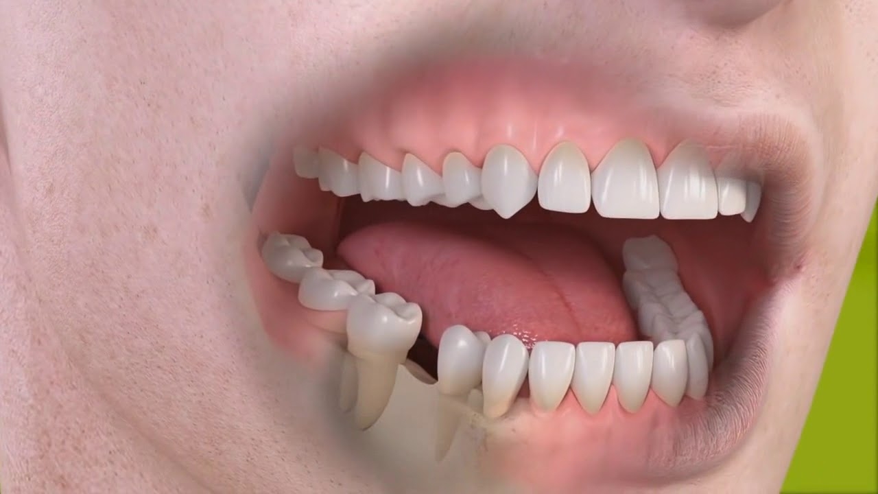 Single tooth implant - Albodent