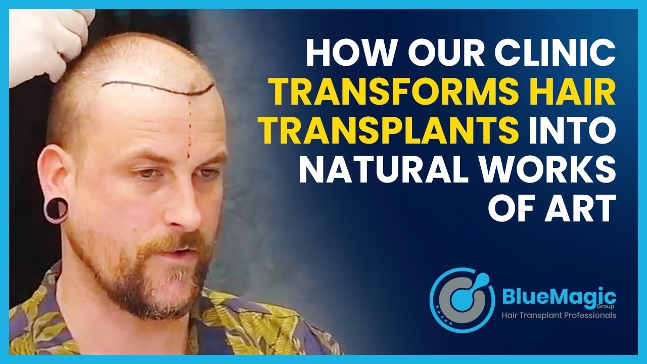 How Our Clinic Transforms Hair Transplants into Natural Works of Art
