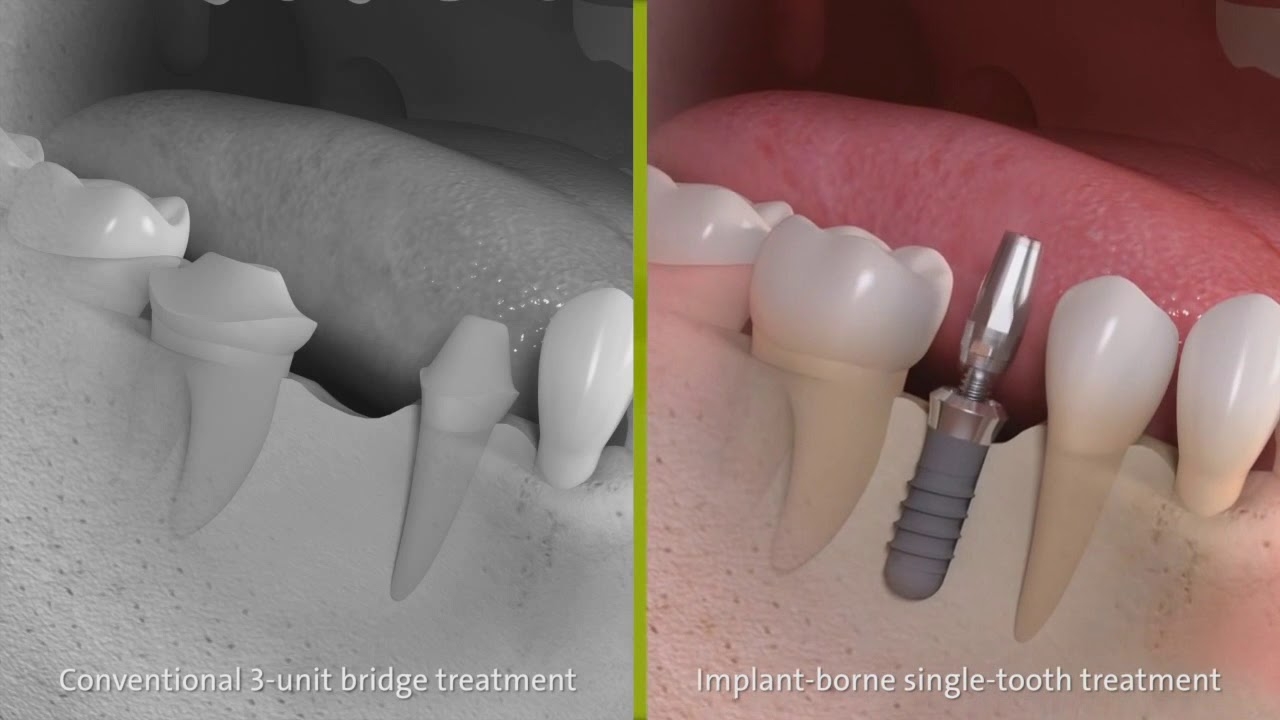 Tooth restoration with a bridge and tooth restoration with an implant - Albodent