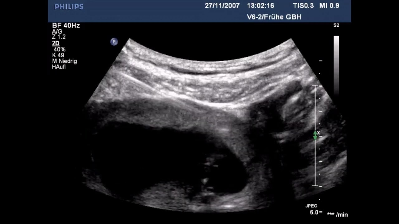 chorionic villus sampling