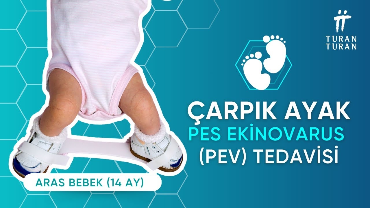 How to Correct Clubfoot (PEV)? Aras' Inspiring Treatment Process
