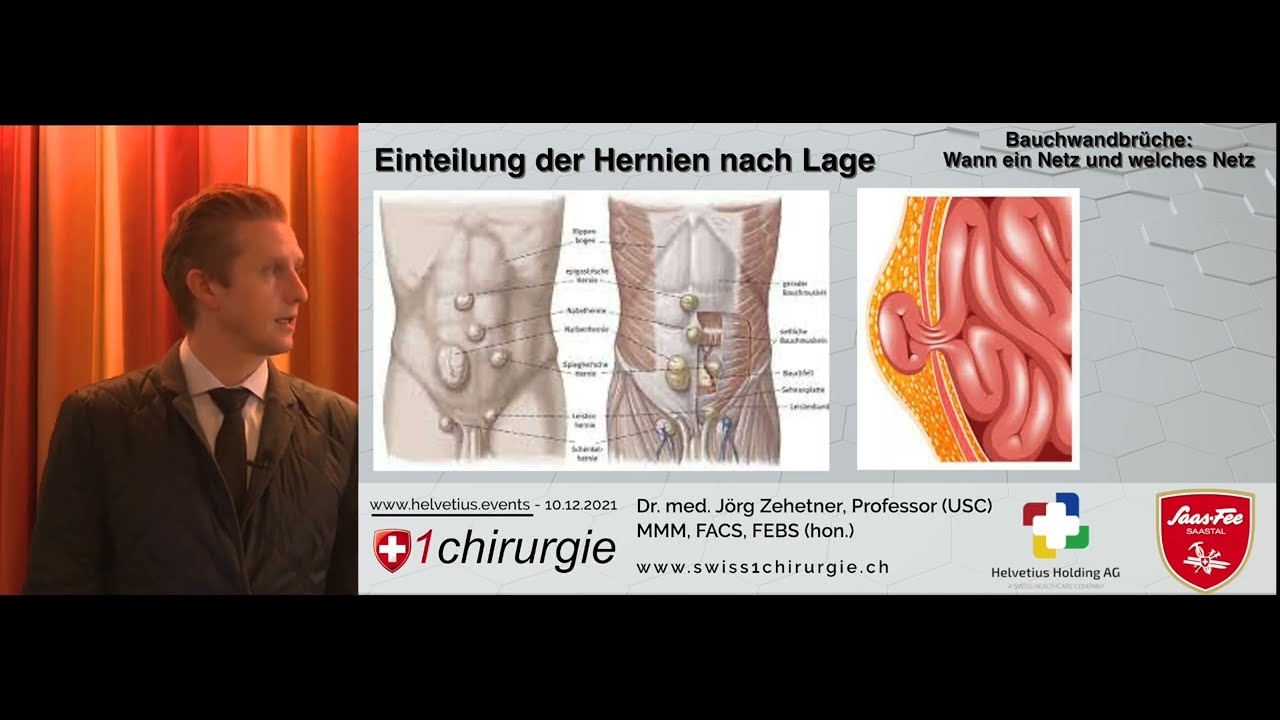 Technical presentation on abdominal wall fractures: When a network and which network | Dr. med. Jörg Zehetner