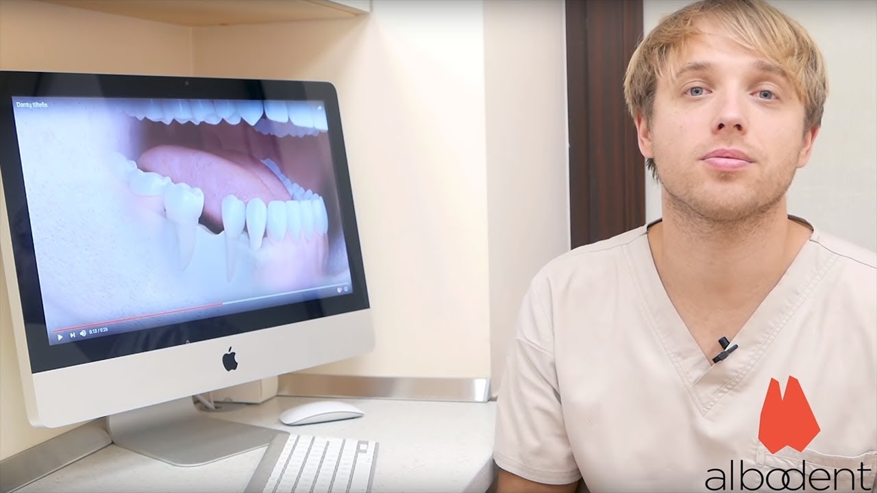 Dental implants - Albodent