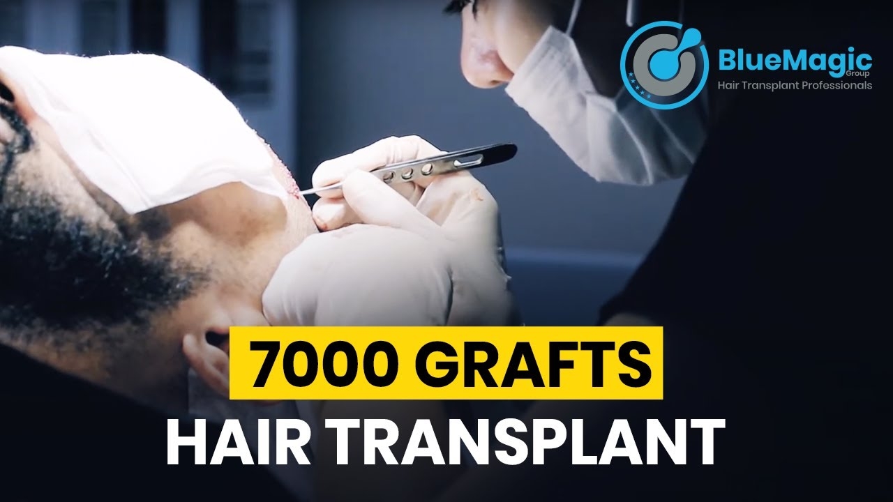 FUE Sapphire Hair Transplant Istanbul | 7000 Grafts Hair Transplant | BlueMagic Group International