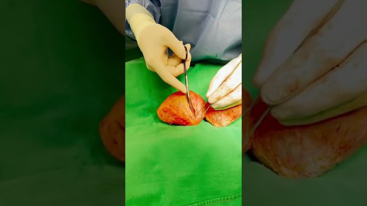 Surgeon G. Samulenas explains what is contracture breast implant #plasticsurgery #breastimplants