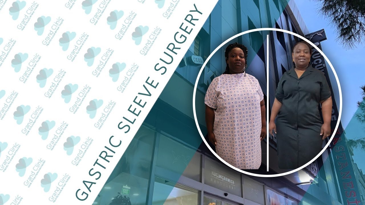 Gastric Sleeve - How much weight can be lost after gastric sleeve? In 1 month, 25 kilos were lost.