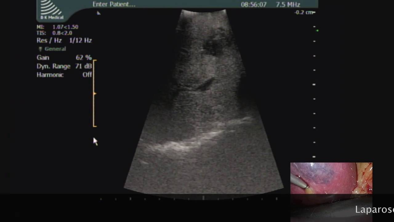 Laparoscopic MicrowaveAblation of Multiple Bilobar Liver Metastases from Ocular Melanoma