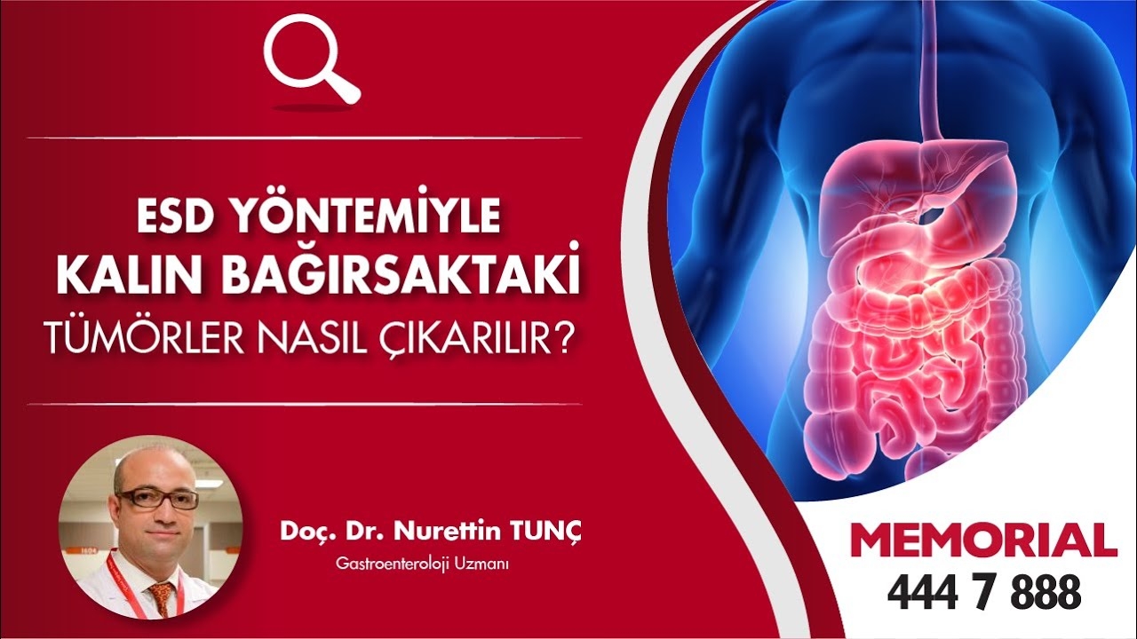 How to remove tumors in the large intestine by the method of ESD (Endoscopic Submucosal Dissection)?