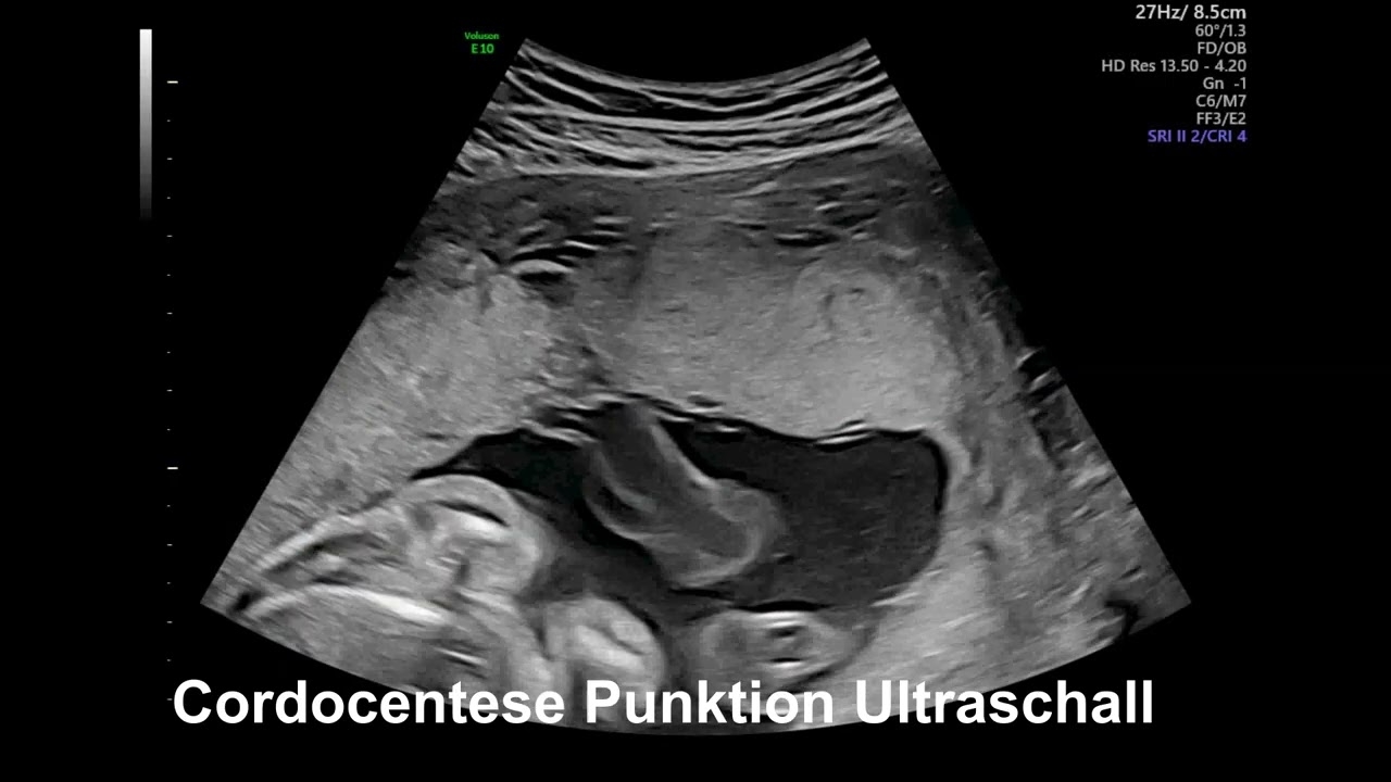 Cordocentesis puncture ultrasound