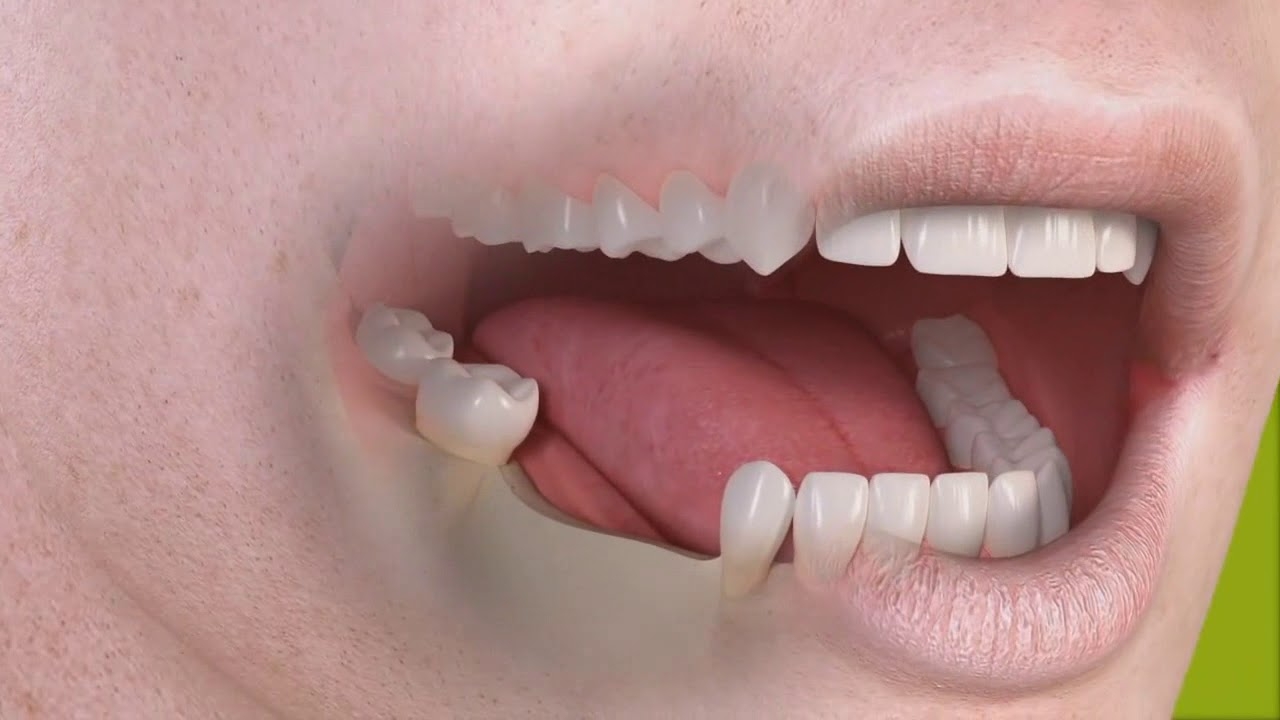 Restoration of several teeth with implants - Albodent
