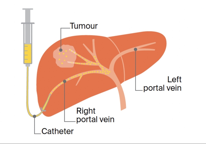 Liver cancer treatment with transarterial chemoembolization (TACE) | 2 sessions | Uniclinic Frankfurt, Germany