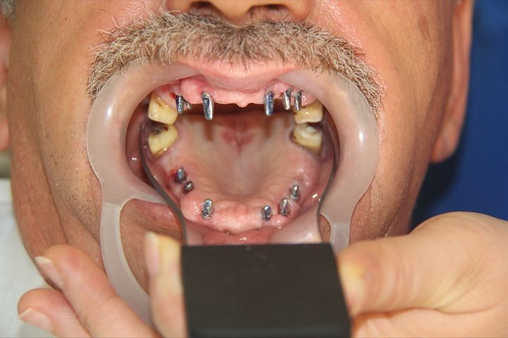 All-on-6 Dental Implants (one arch) | Evoss Implant + Zirconium Crown