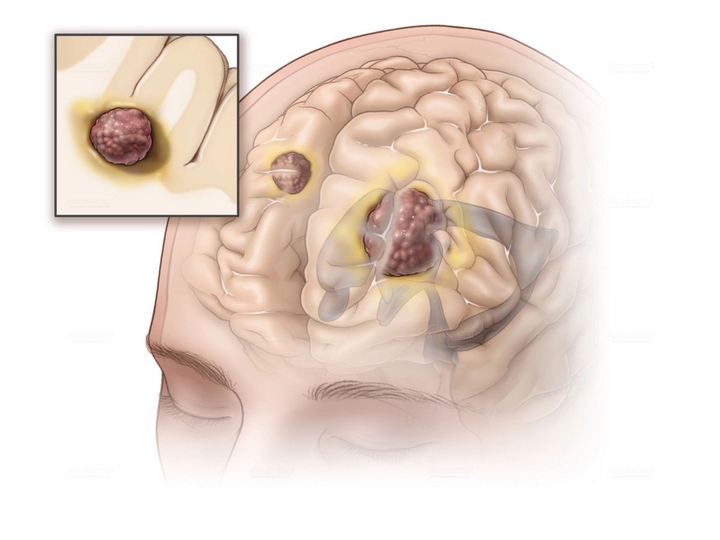 Pre-Surgical Epilepsy Diagnostics at Beta Clinic Bonn