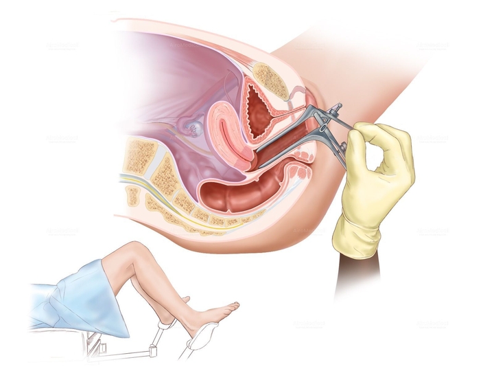 Uterine fibroid (myoma) embolization - Minimally invasive therapy | Uniclinic Frankfurt, Germany