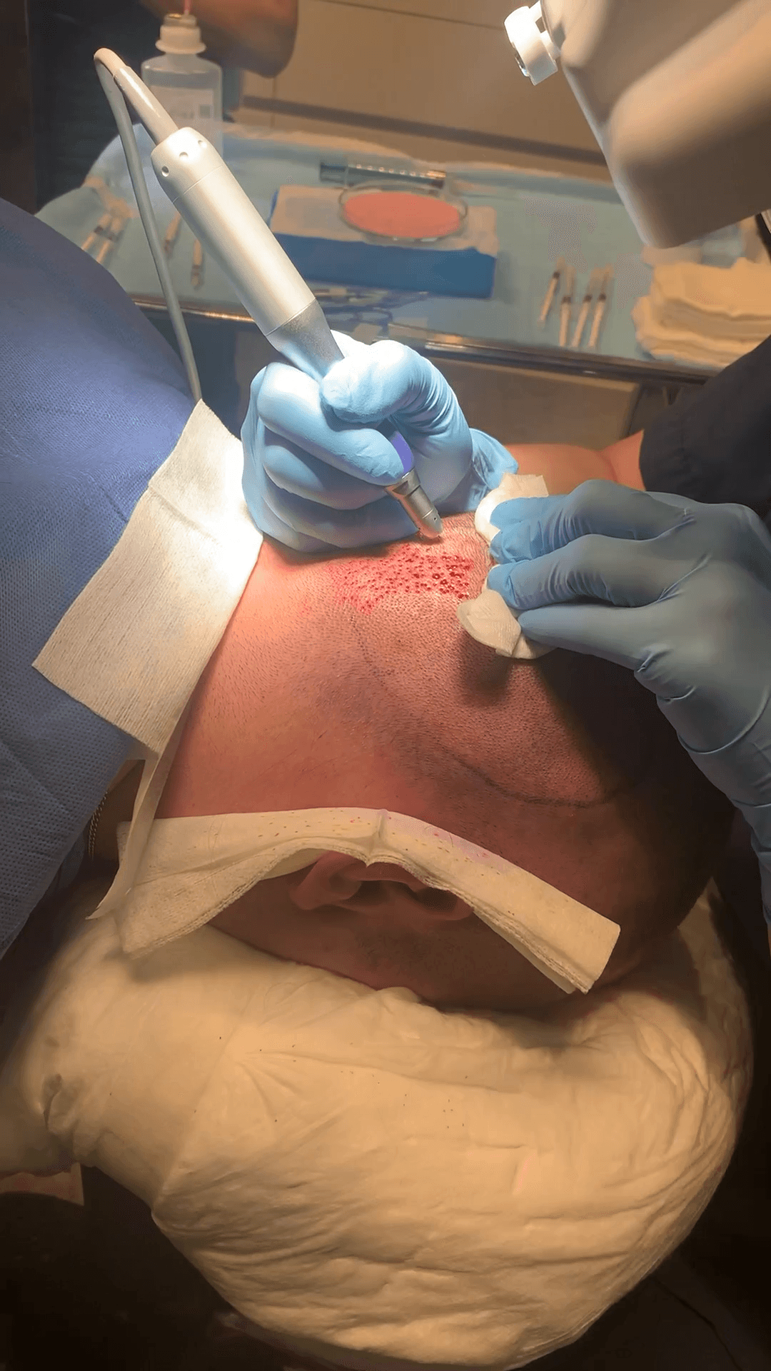 Extraction during hear transplant