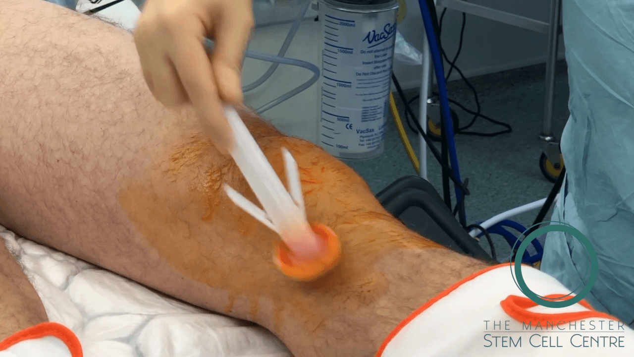 Stem cells SVF Technology