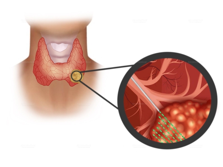 Polydactyly Surgery - Extra Finger Removal | Clinic for Plastic & Hand Surgery at University Hospital rechts der Isar, Munich, Germany