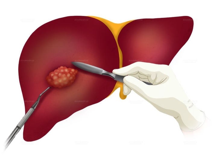 Excimer Laser-Assisted Angioplasty (ELA) for Peripheral Arterial Occlusive Disease at Interventional Radiology Clinic at University Hospital Frankfurt