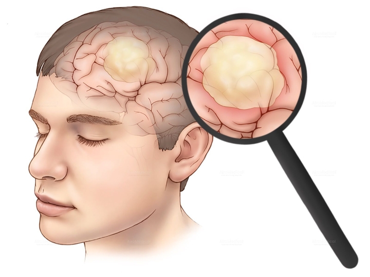 Retrograde Transvenous Embolization of Peripheral Arteriovenous Malformations | University Hospital Halle (Saale)