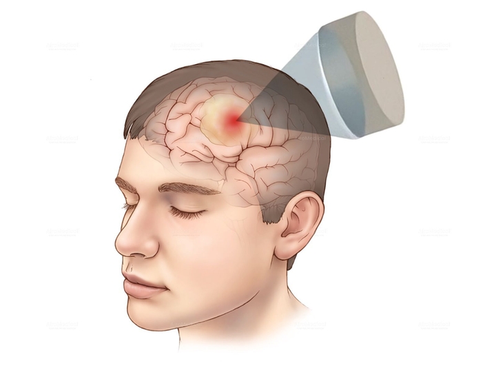 Resective Epilepsy Surgery at Beta Clinic Bonn