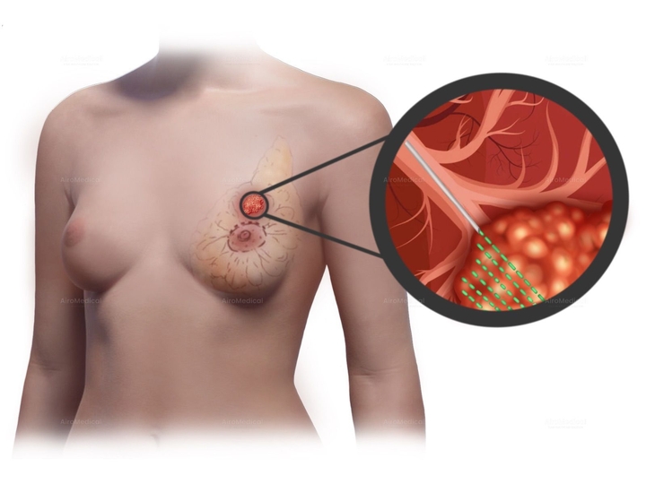 Brain Tumor Removal Operation | Clinic for Neurosurgery at Motol University Hospital