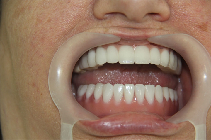 All-on-4 Dental Implants (one arch) | Evoss Implant + Zirconium Crown
