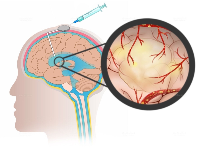 Neurostimulation Procedure - Deep Brain Stimulation (DBS) for Epilepsy | Beta Clinic Bonn