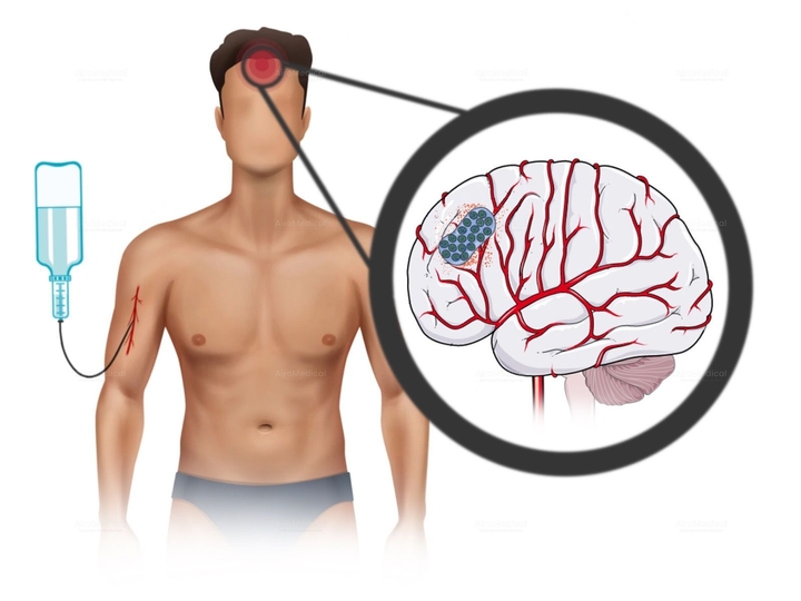Neurostimulation Procedure - Vagus Nerve Stimulation (VNS) for Epilepsy | Beta Clinic Bonn