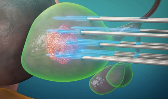 Brachytherapy for Prostate Cancer Treatment
